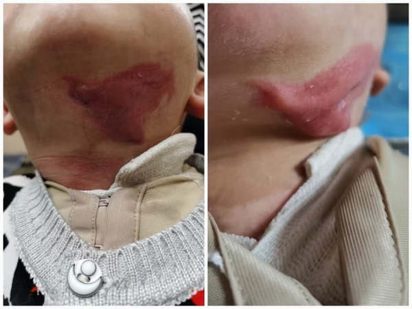 疤痕增生疤痕增生疤痕增生疤痕增生又称疤痕瘤,是由纤维结缔组织过度